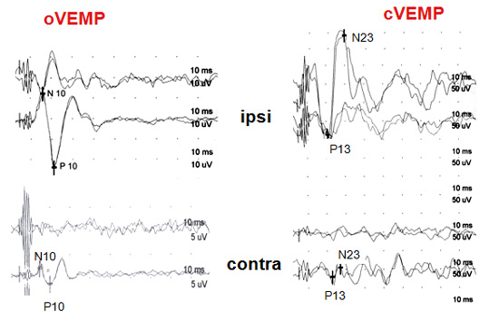 augmentation-des-vemps