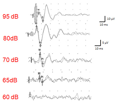 diminution-seuil-vemp